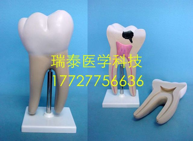 Model zęba - nauka medyczna - próchnica - PVC - 2 części - 24x24x30cm - Wianko - 2