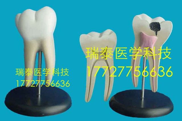 Model zęba - nauka medyczna - próchnica - PVC - 2 części - 24x24x30cm - Wianko - 3